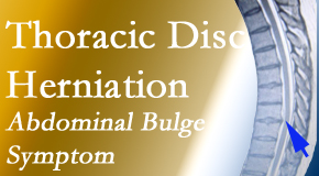 Chiropractic Spine Sports And Rehabilitation cares for thoracic disc herniation that for some patients prompts abdominal pain.