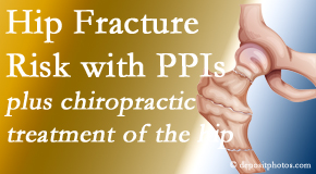 Chiropractic Spine Sports And Rehabilitation shares new research describing higher risk of hip fracture with proton pump inhibitor use. 