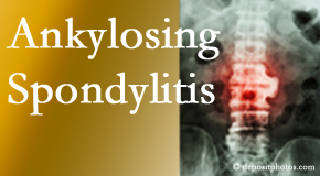 Ankylosing spondylitis is gently cared for by your Tonawanda chiropractor.