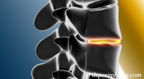 Tonawanda degenerative spinal changes 
