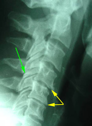 disc degeneration treated at Chiropractic Spine Sports And Rehabilitation