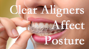 Clear aligners influence posture which Tonawanda chiropractic helps.