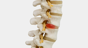 Tonawanda chiropractic conservative care helps even huge disc herniations go away