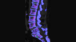 Chiropractic Spine Sports And Rehabilitation is aware that inflammatory spinal gout is a differential diagnosis to consider for patients who present with back pain and other spine related symptoms.