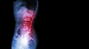 Tonawanda Chiropractic Care of Spondylolisthesis 