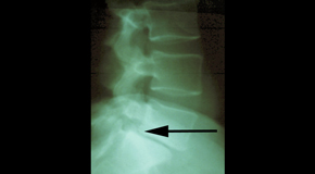 Tonawanda spondylolisthesis 