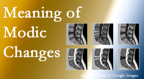 Chiropractic Spine Sports And Rehabilitation sees many back pain and neck pain patients who bring their MRIs with them to the office. Modic changes are often seen. 