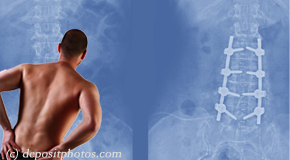 Tonawanda chiropractic respite for back pain after back surgery
