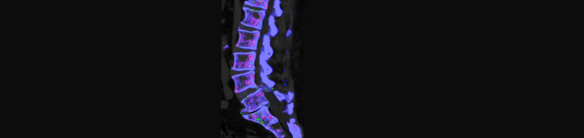 Chiropractic Spine Sports And Rehabilitation is aware that inflammatory spinal gout is a differential diagnosis to consider for patients who present with back pain and other spine related symptoms.