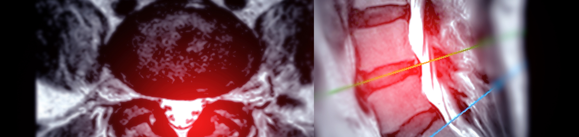 Tonawanda back pain imaging and exercise