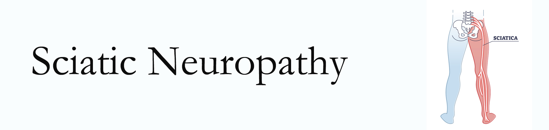 Tonawanda neuropathy pain (sciatica)