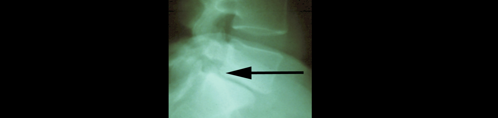 Tonawanda spondylolisthesis