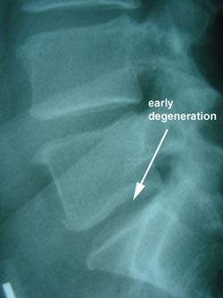 disc degeneration picture