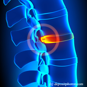 image of lumbar Tonawanda disc herniation