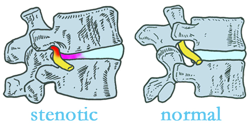 Tonawanda stenotic and normal spinal discs